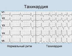 Тахикардия увеличение частоты сердечных сокращений